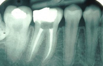 endodonti 002